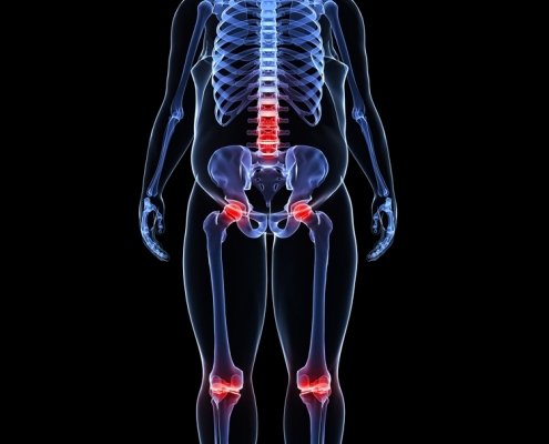 Come obesità e sovrappeso favoriscono l'osteoporosi