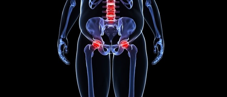 Come obesità e sovrappeso favoriscono l'osteoporosi